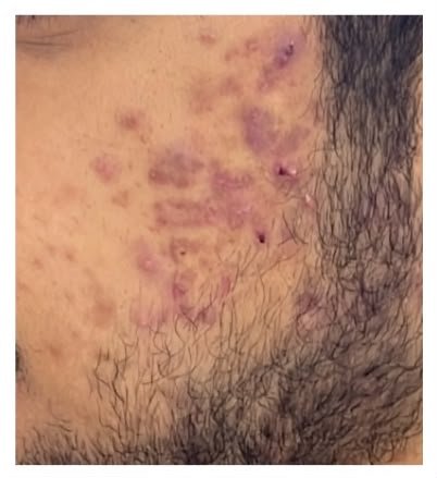 قبل العلاج